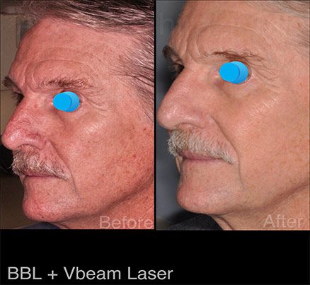 Side Of Man Before & After Photorejuvenation