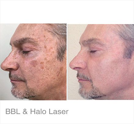 Left Profile Of Man Before & After Halo Laser Treatment