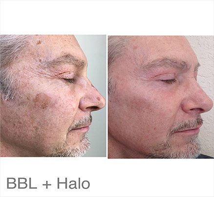 Profile Of Man Before & After Halo Treatment For Spots