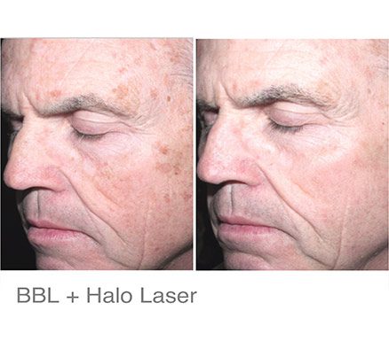 Side Of Man Before & After Laser Treatment