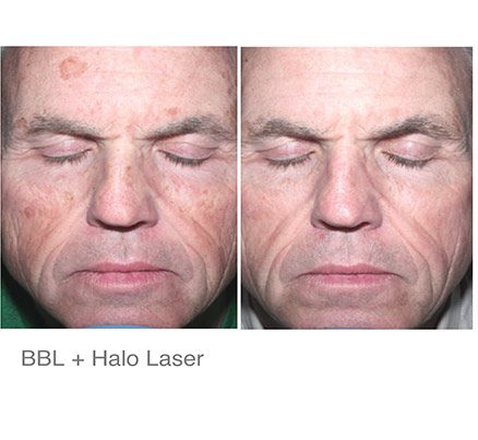 Man Before & After Halo Laser Treatment
