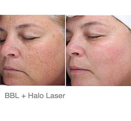 Woman Before & After Halo Laser Treatment For Spot Removal
