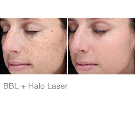 Woman Before & After Halo Laser Treatment For Spots