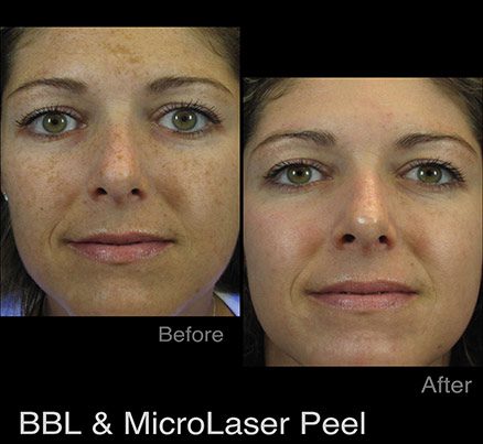 Woman Before & After MicroLaser Peel