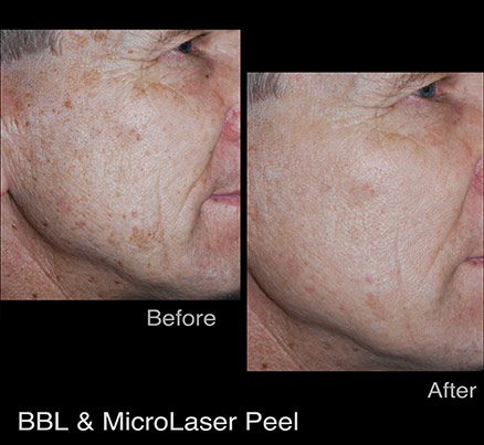 Man's Cheek Before & After MicroLaser Peel