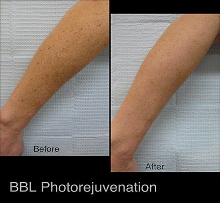 Arm Before & After Photodynamic Therapy