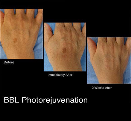 Hand Before & After Photodynamic Therapy For Spots