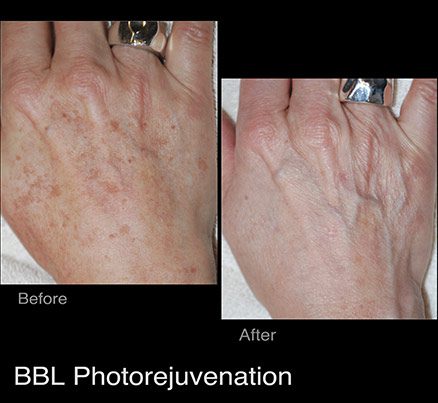 Hands Before & After Photodynamic Therapy