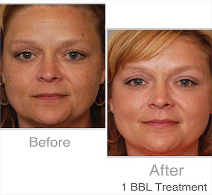 Woman Before & After Photodynamic Therapy For Spots