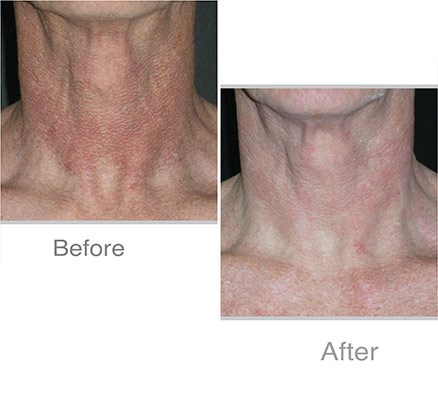 Neck Before & After Photodynamic Laser Treatment