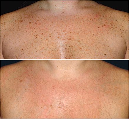 Before & After Laser Treatment For Spots On Chest
