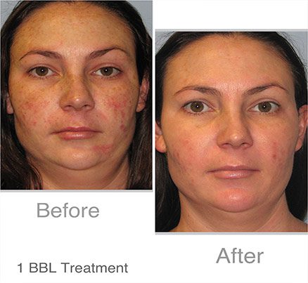 Woman Before & After Laser Treatment For Red Spots