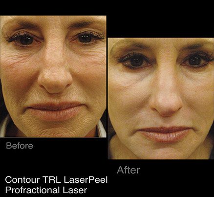 Woman Before & After Photodynamic Therapy