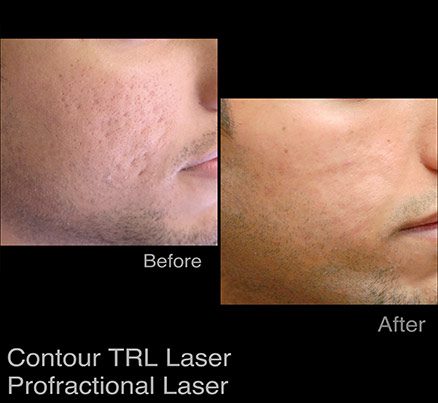 Man Before & After Photodynamic Therapy For Acne Scar