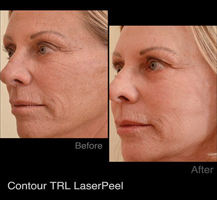 Profile Before & After Blue Light Photodynamic Therapy