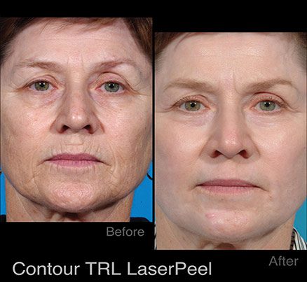 Lady Before & After Blue Light Photodynamic Therapy