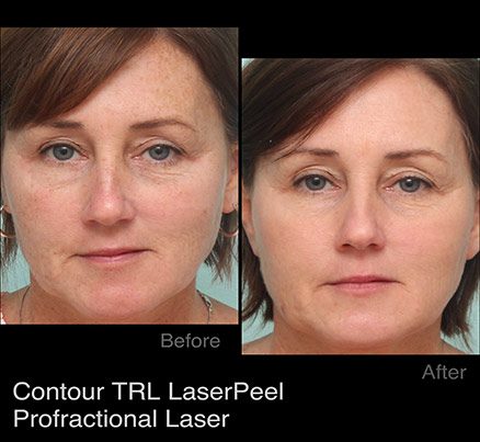 Woman's Face Before & After Blue Light Photodynamic Therapy