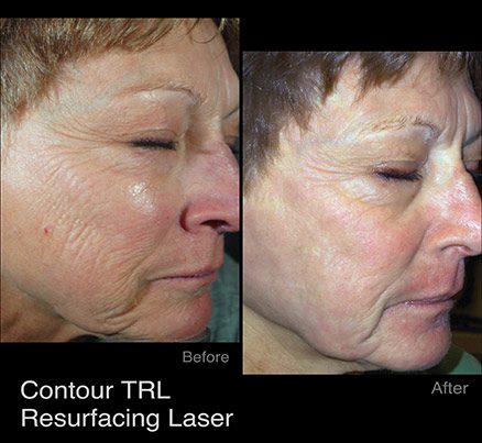 Woman's Face Before & After Resurfacing Laser