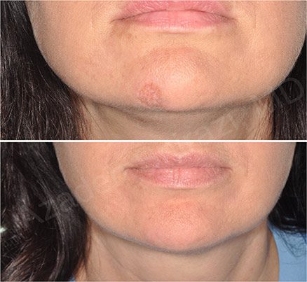 Woman's Chin Before & After Laser Scar Removal