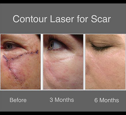 Woman's Face Before & After Laser Scar Removal