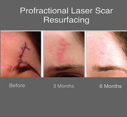 Before & After Laser Scar Removal Treatment