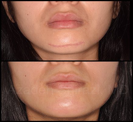 Chin Before & After Laser Scar Removal