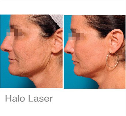Woman Before & After Halo Laser Treatment On Face & Neck