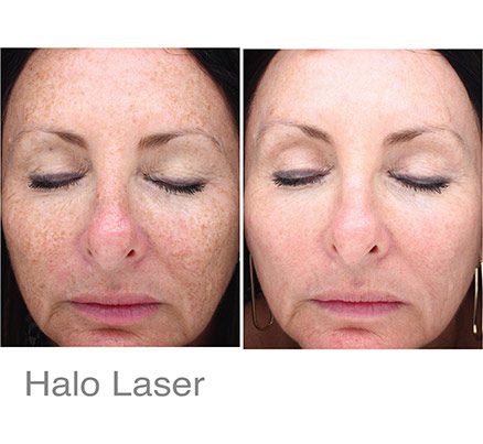 Woman Before & After Halo Lasers For Spot Removal