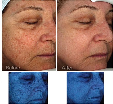 Woman Before & After Halo Laser Treatment Under Black Lighting