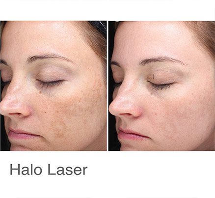 Woman Before & After Using Halo Laser