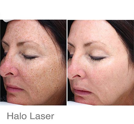 Woman Before & After Halo Laser Treatment For Freckles