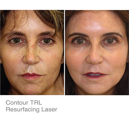 Woman Before & After Resurfacing Laser For Spots