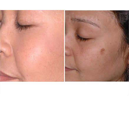 Woman's Cheek Before & After Spot Removal
