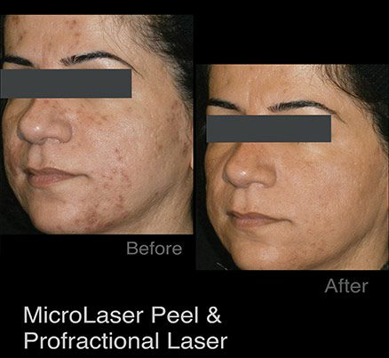 Woman Before & After Photodynamic Acne Therapy