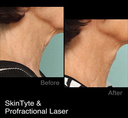 Woman's Neck Before & After SkinTyte & Profractional Laser
