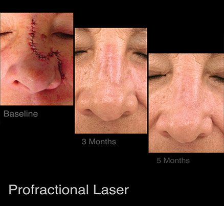 Before & After Profractional Laser Scar Removal