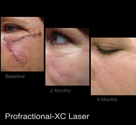 Before & After Laser Scar Removal Under Eye