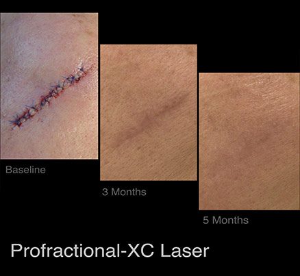 Before & After Laser Scar Removal