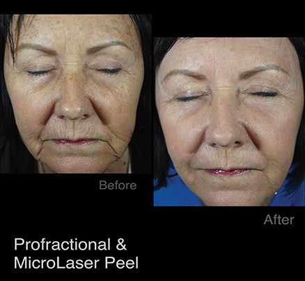 Woman Before & After Deep Wrinkle Treatment