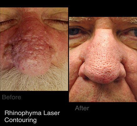 Man Before & After Rhinophyma Laser Contouring