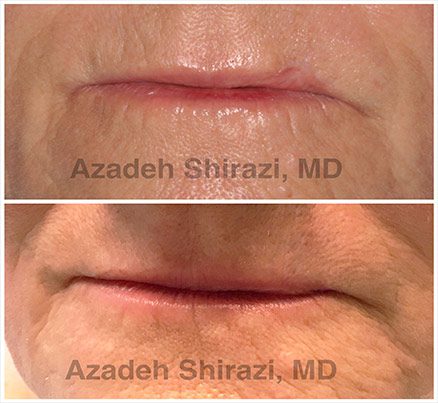 Mouth Area Before & After Laser Treatment