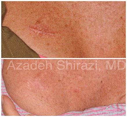 Chest Before & After Laser Scar Removal Treatment