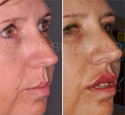 Woman Before & After Laser Treatment On Lip