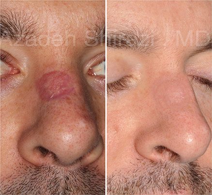 Man Before & After Mohs Laser Surgery