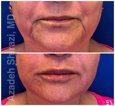 Lip Area Before & After Lip Rejuvenation