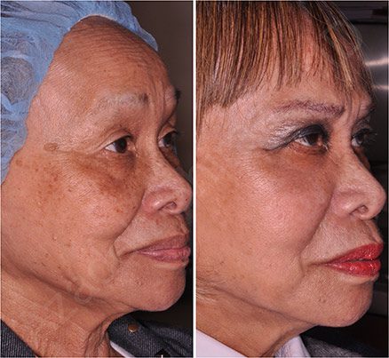 Woman Before & After Skin Rejuvenation Treatment