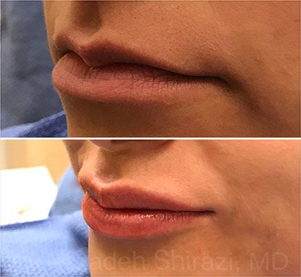 Lips Before & After Juvederm Filler
