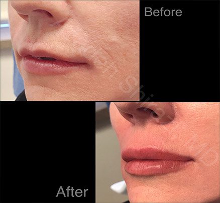 Restylane Filler Before & After