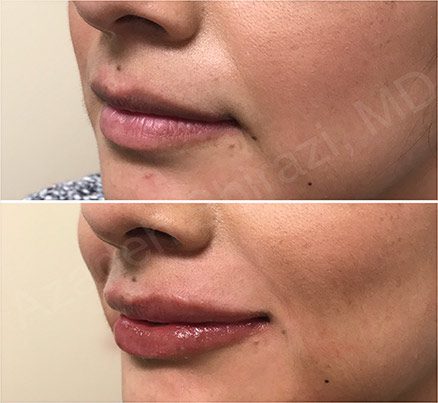 Women's Lips Before And After Restylane Filler