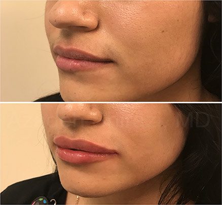 Before & After Restylane Filler